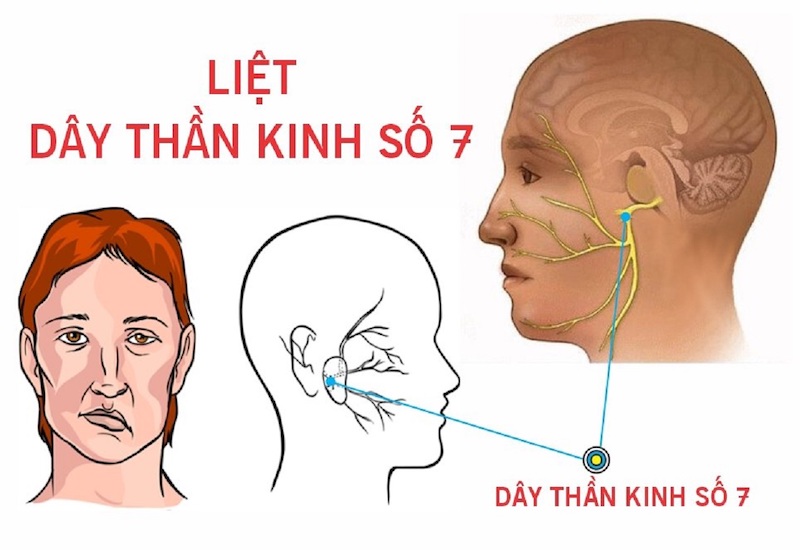 1. Liệt dây thần kinh số 7 là gì?