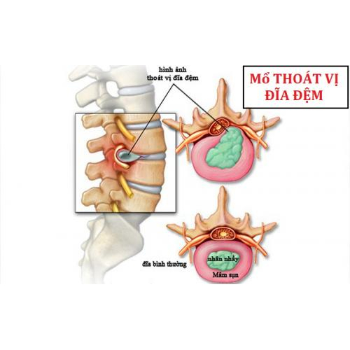 Thoát Vị Đĩa Điệm Có Mổ Không?